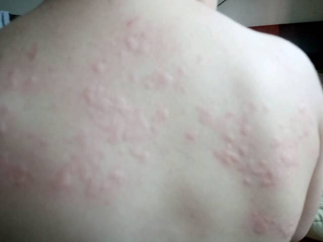 宝宝急性荨麻疹怎么办