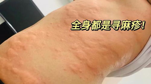再说最后一遍 荨麻疹就用这三招,想不治好都难 千万别错过
