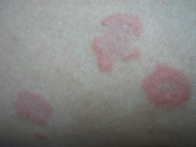 产后荨麻疹的症状图片