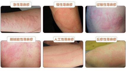 了解荨麻疹,战胜荨麻疹_风团