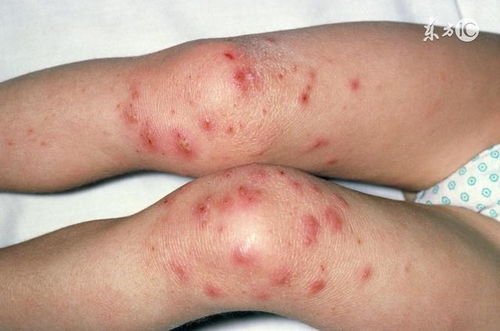 被扔掉的杂草，竟是皮肤问题的克星？加点料，湿疹荨麻疹不再复发