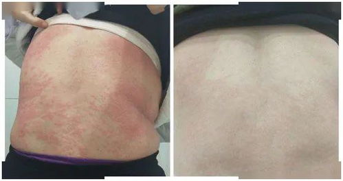 长期患有荨麻疹，别不当回事，科学治疗很关键