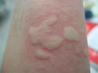 了解过敏性荨麻疹 症状、原因与应对方法