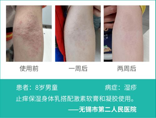 秋冬湿疹频繁复发？海得宝守护宝宝娇嫩肌肤