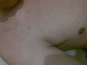 啤酒过敏与荨麻疹 了解症状、原因及应对措施