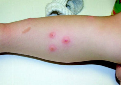 丘疹性荨麻疹 水泡图片、典型症状及科学治疗方法