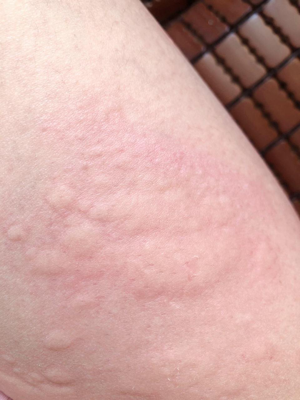 荨麻疹的民间调理思路 一份来自经验的分享