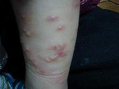 丘疹性荨麻疹 症状详解与图片辨识指南