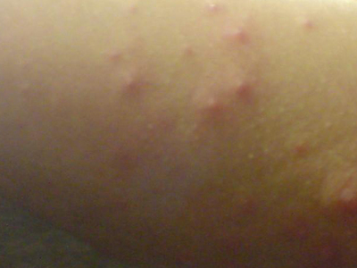 丘疹性荨麻疹图片与症状识别——详解这种常见的皮肤过敏反应